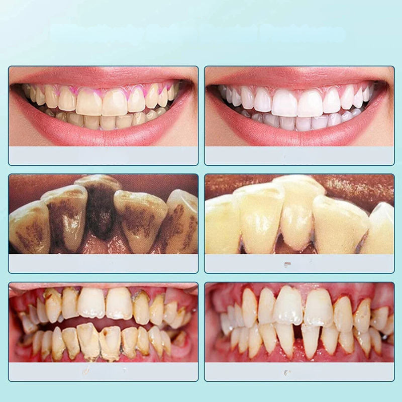 FreshSmile Ultraschall-Zahnbürste – Für Saubere sowie Gesunde Zähne