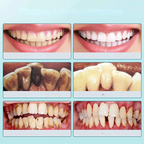 FreshSmile Ultraschall-Zahnbürste – Für Saubere sowie Gesunde Zähne